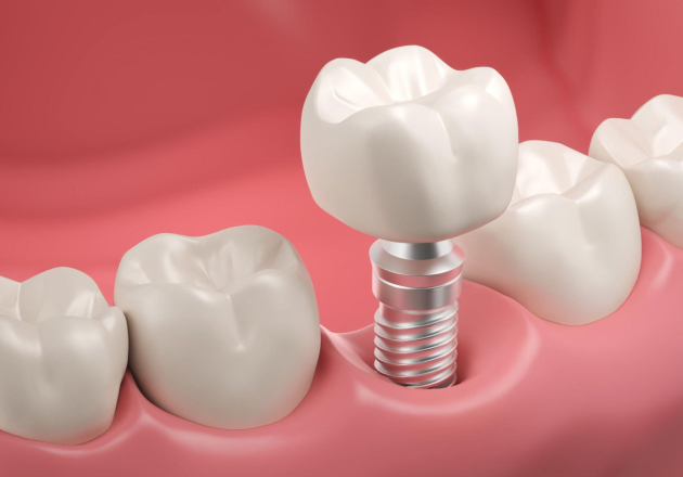 Dental implants Houston
