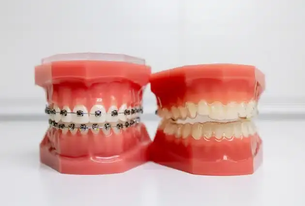 Dental models showing orthodontic braces on upper and lower teeth for treatment planning.