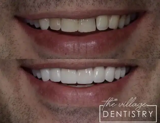 Before and after smile transformation showing improved tooth alignment and brightness from restorative dentistry treatment.